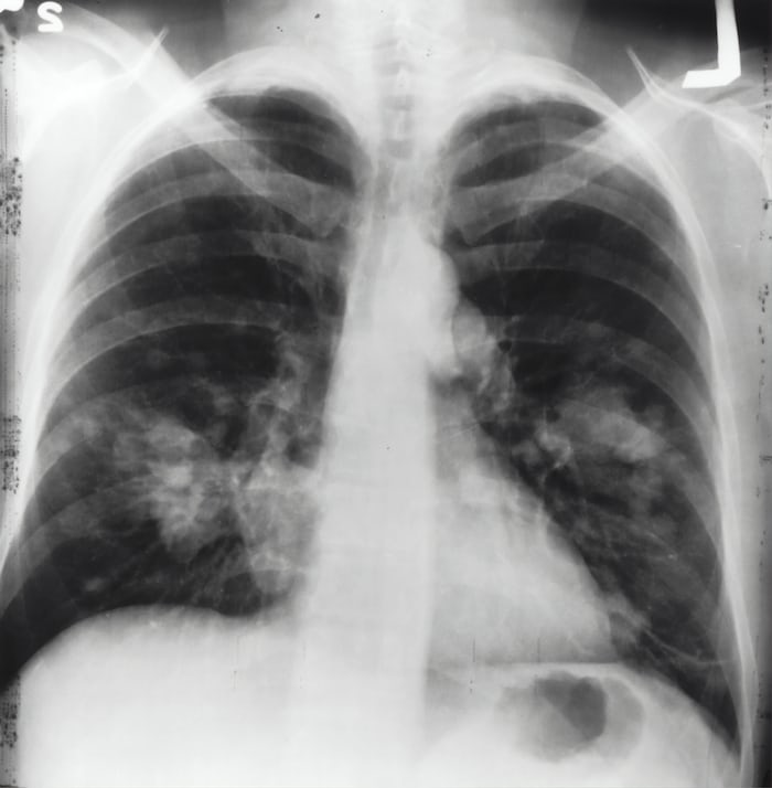 Pneumonia: A Serious Lung Infection
