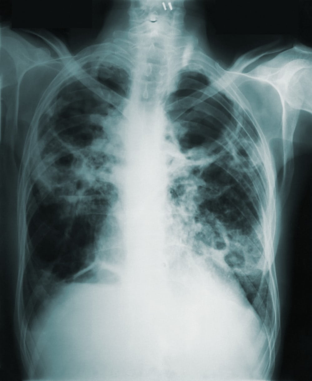 Read more about the article Tuberculosis (TB): A Serious but Curable Disease