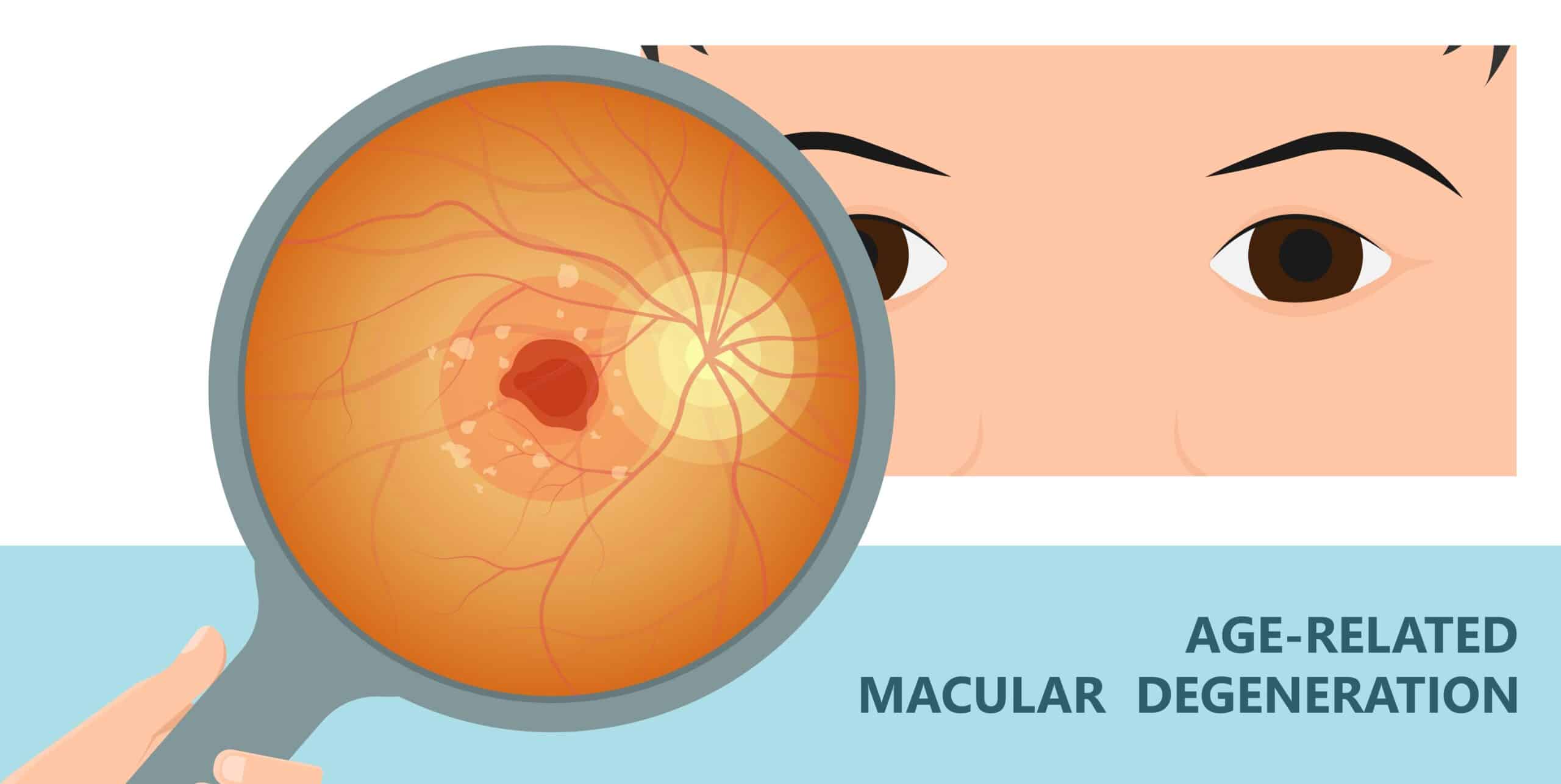 Read more about the article Age-Related Macular Degeneration (AMD): Symptoms, Causes, and Treatments